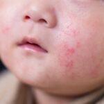 Infant Circumcision and Atopic Conditions: What Parents Should Know About Skin Sensitivity and Allergy Risks