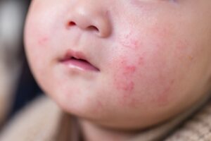 Infant Circumcision and Atopic Conditions: What Parents Should Know About Skin Sensitivity and Allergy Risks